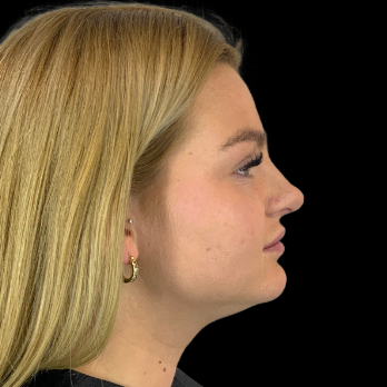 preservation-rhinoplasty-after